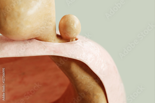 Mixed form of hiatus hernia type 3 - entrance to the stomach and protrusion of the stomach through the diaphragm - 3D rendering photo