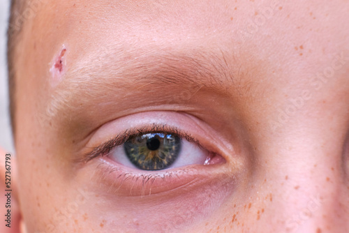 A child's eye with freckles. A wound on a child's head