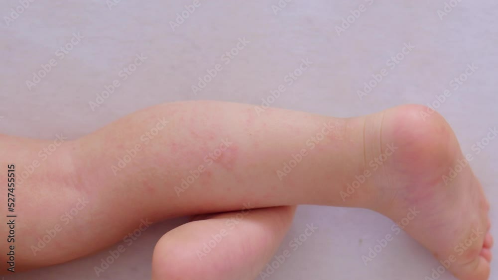 allergic skin on child's legs, red rash dermatitis, close-up atopic eczema allergy. baby kid atopy diathesis reaction on food, irritation dermatology problem skin. medicine itchy illness allergic skin on child's legs, red rash dermatitis, close-up atopic eczema allergy. baby kid atopy diathesis reaction on food, irritation dermatology problem skin. medicine itchy illness