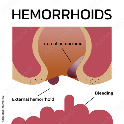anal, anatomy, anus, bleeding, blood, cartoon, digestion, external, hemorrhoid, illustration, infographic, internal, rectal, swelling, vector
