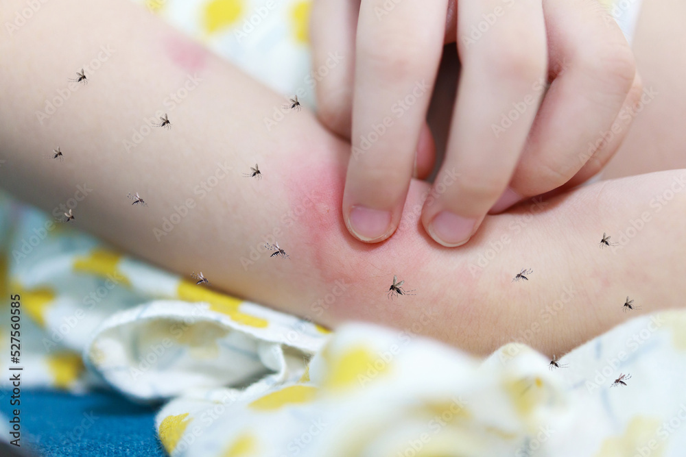 Little girl has skin rash allergy and itchy on her arm from mosquito bite Little girl has skin rash allergy and itchy on her arm from mosquito bite