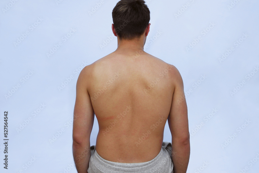 Curved spine with scoliosis, posture correction. Naked male back