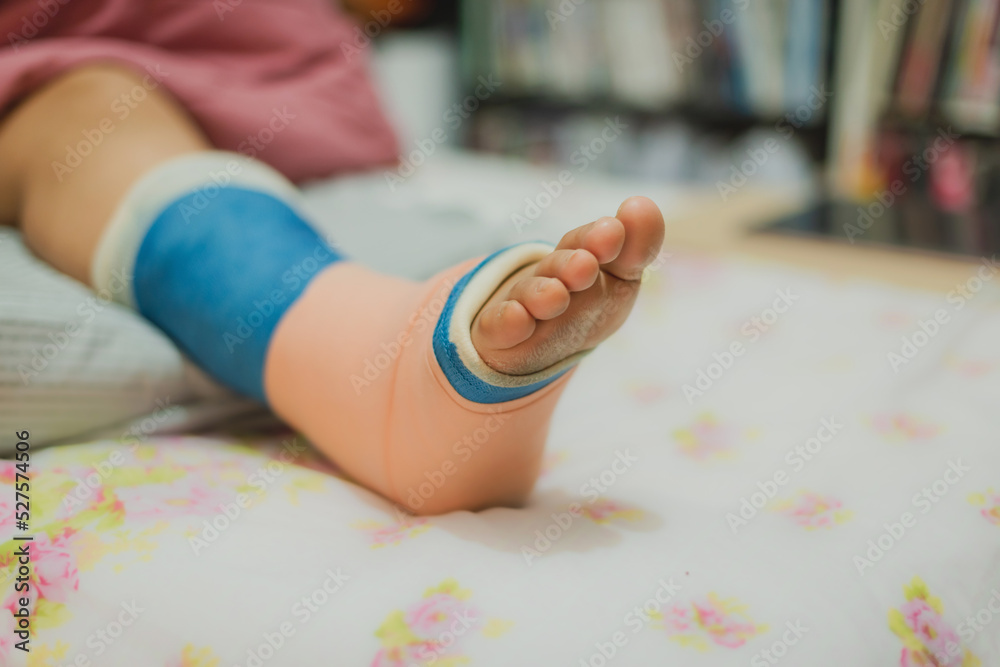 Close-up Of A Women's Broken Leg . Close-up Of A Women's Broken Leg .