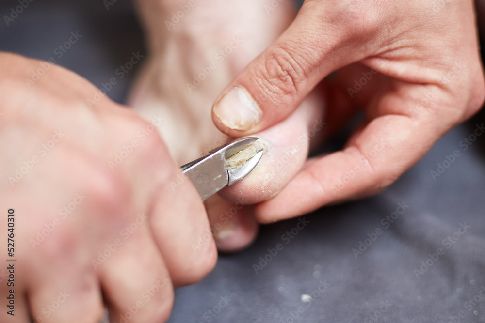 Natural Remedies for Fungal Nail Infections