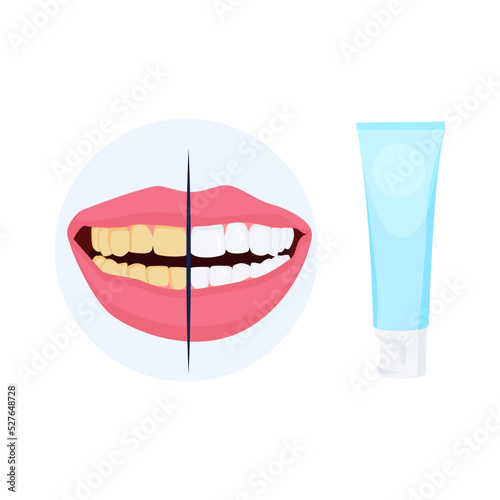 Yellowed teeth, teeth whitening treatment. Tooth paste.