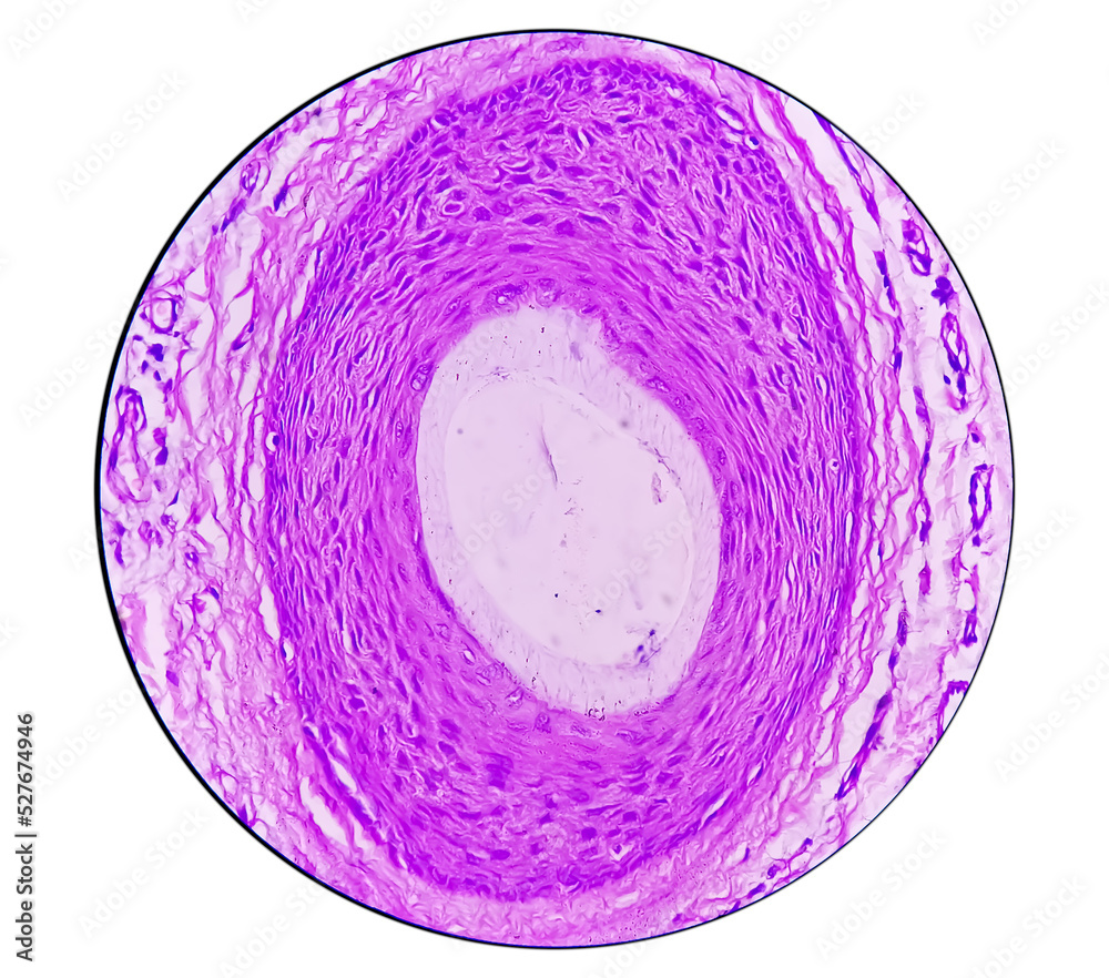 Histological biopsy of Scrotal wall under microscopy showing Calcinosis