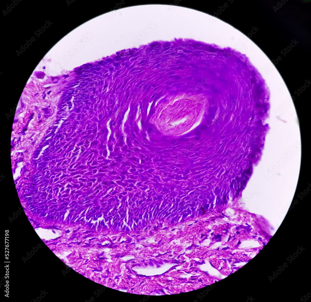 Skin Biopsy Suggestive Of Basal Cell Carcinoma The Most Common Type