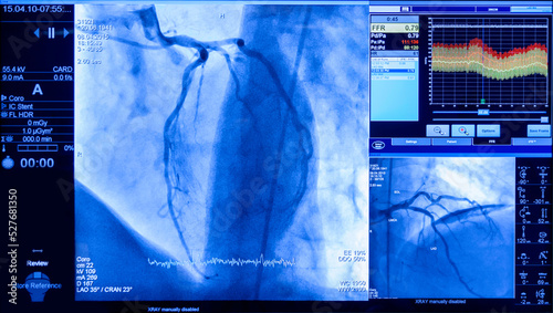 projection of veins on the screen in heart surgery, transcatheter aortic valve implantation, Preparation of the Volcano Refinity IVUS Catheter, intravenous imaging photo