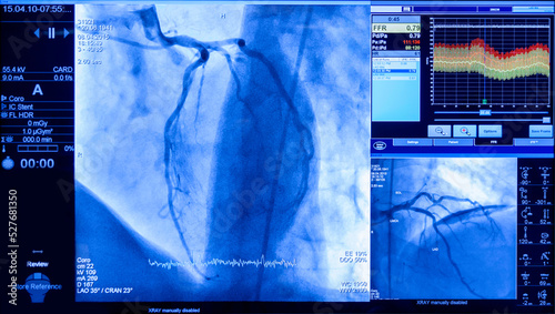 Obraz na plátne projection of veins on the screen in heart surgery, transcatheter aortic valve i