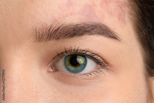 Young woman with heterochro...