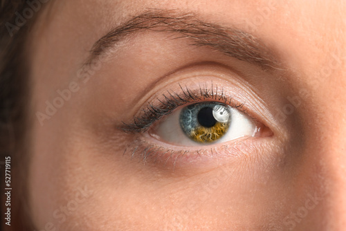 Young woman with heterochro...