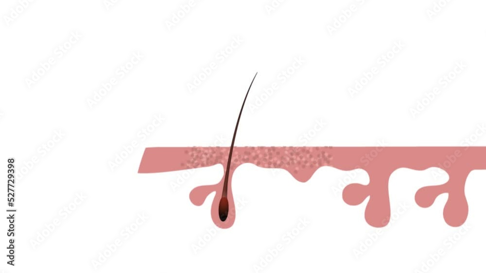 Shrinking of hair follicles result in hair loss, baldness, alopecia. The diagram represents this