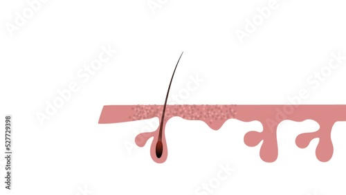 Shrinking of hair follicles result in hair loss, baldness, alopecia. The diagram represents this decrease of follicle size contributing to hair fall. 