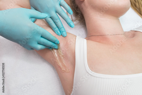 Depilation and epilation of the female armpit with liquid sugar paste. The beautician s hand applies wax paste to the armpit.