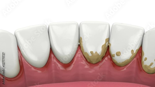 Removing tartar and plaque from teeth by ultrasonic scaler. Dental descaling concept