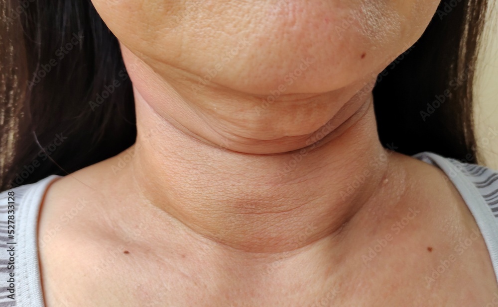 close up of a woman showing the flabbiness adipose sagging skin under the neck, wrinkles and flabby skin, problem cellulite and rough skin under the chin of the woman, concept health care. close up of a woman showing the flabbiness adipose sagging skin under the neck, wrinkles and flabby skin, problem cellulite and rough skin under the chin of the woman, concept health care.
