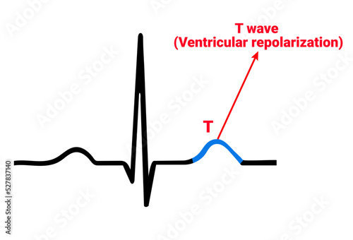 Structure of T wave (Ventricular repolarization)