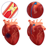 Coronary bypass. Surgery to restore blood flow in the arteries of the heart. Vector illustration.