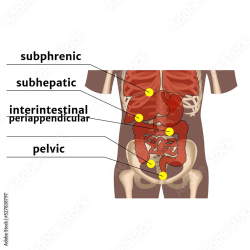 Abscesses of the abdominal cavity. Diagram with types and location of purulent diseases. Medical poster. Vector illustration
