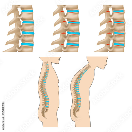 Spondylitis. Inflammatory disease of the spine. Destruction of the vertebral bodies, stages of spinal deformity. Vector illustration