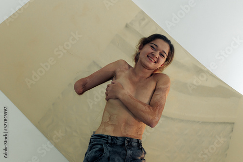 Happ young woman with amputee arm and scars from burn on her body poses lying topless. The concept of a fulfilling life of persons with disabilities. photo