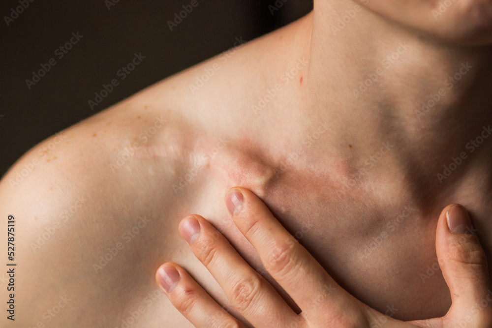 Close-up of man's collarbone injury. Black background. Injured athlete after successful fractured clavicle bone surgery. Close-up of man's collarbone injury. Black background. Injured athlete after successful fractured clavicle bone surgery.