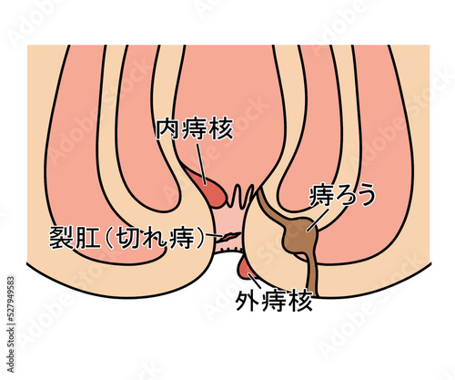 Obraz w ramie 痔（内痔核・外痔核・痔ろう・裂肛）