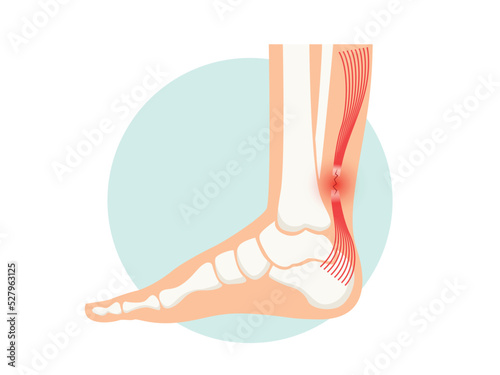 Achilles tendon rupture anatomical poster. Ankle injury, ligament sprain and tear problems photo