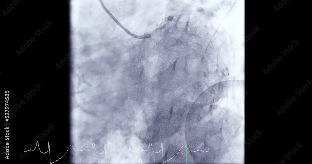 Coronary angiogram of coronary artery during cardiac catheterization in