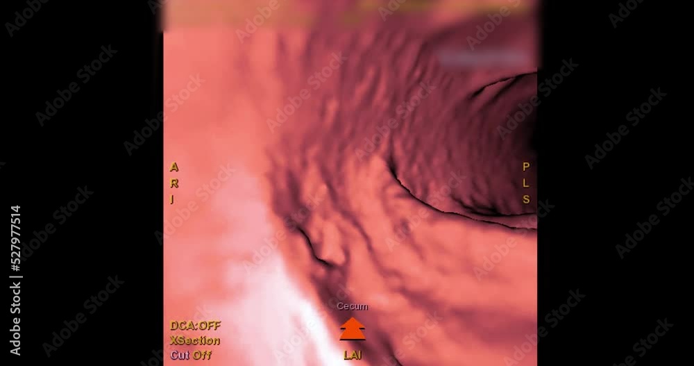 CT colonography or CT Scan of large intestine 3D rendering on the ...