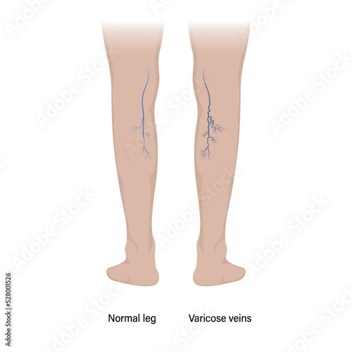 Legs with normal veins and legs with varicose veins.