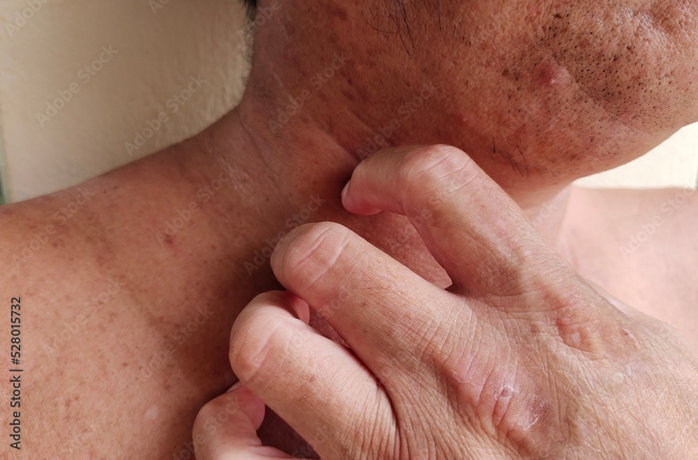 Portrait showing dryness skin infections, allergic reactions and rash on the body, problem dark spots and acne skin, scratch itchy of the male patient, concept health care. Portrait showing dryness skin infections, allergic reactions and rash on the body, problem dark spots and acne skin, scratch itchy of the male patient, concept health care.