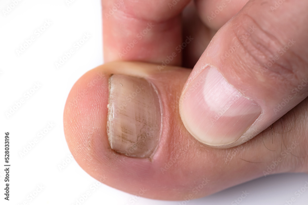 Toe nail with psoriasis and healthy toe nails, Psoriatic nail, close-up. Toe nail with psoriasis and healthy toe nails, Psoriatic nail, close-up.