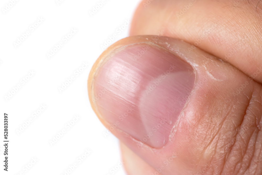Ridged fingernail of a thumb finger of a man with vertical ridges on white background Ridged fingernail of a thumb finger of a man with vertical ridges on white background