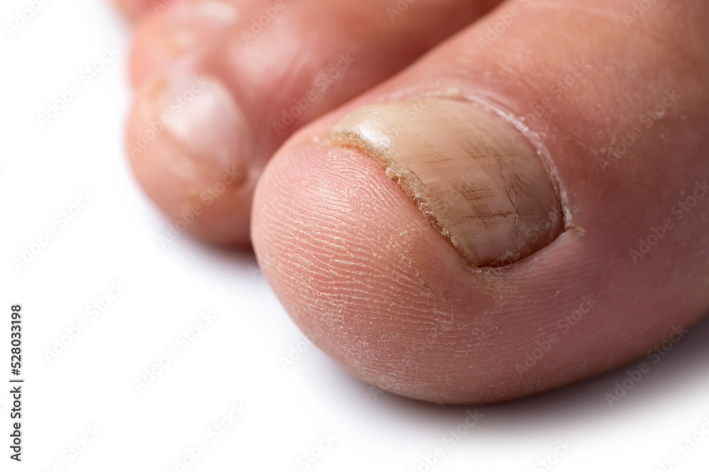 Close up image of a finger with nail fungus infection Close up image of a finger with nail fungus infection