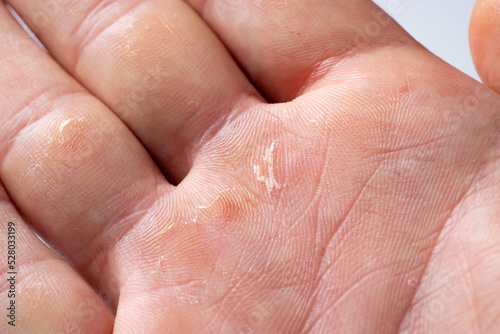 Hand with blister and callus close up photo