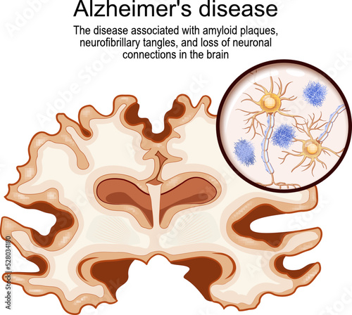 Alzheimer's disease. Brain and neurons with amyloid plaques