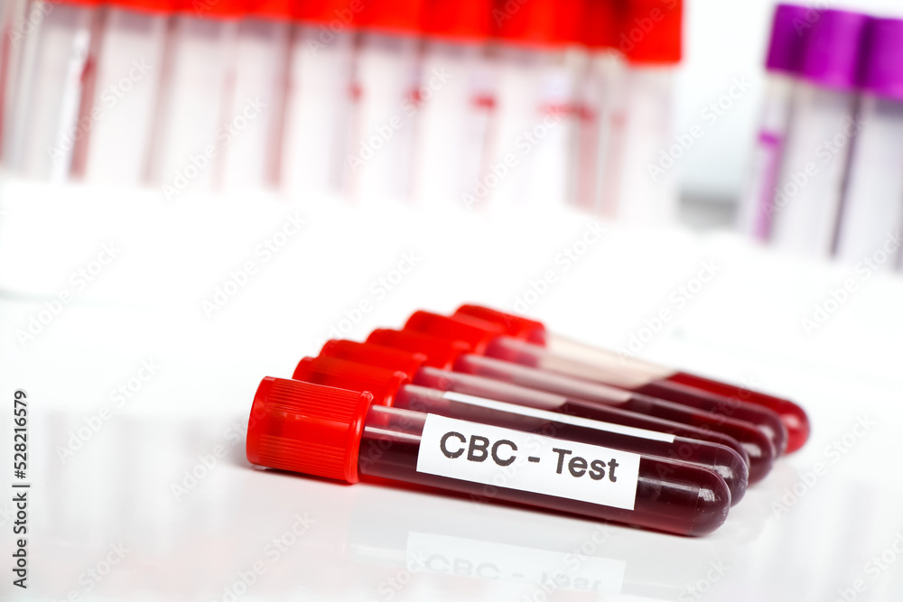 CBC test for abnormalities in red blood cells, Blood samples to be analyzed in the laboratory CBC test for abnormalities in red blood cells, Blood samples to be analyzed in the laboratory