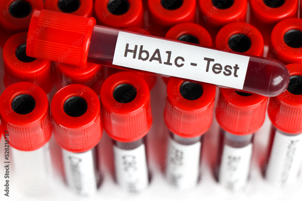 HbA1c test from blood , Blood samples to be analyzed in the laboratory