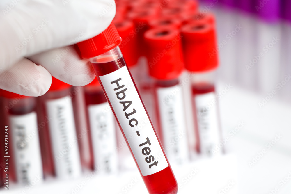 HbA1c test from blood , Blood samples to be analyzed in the laboratory