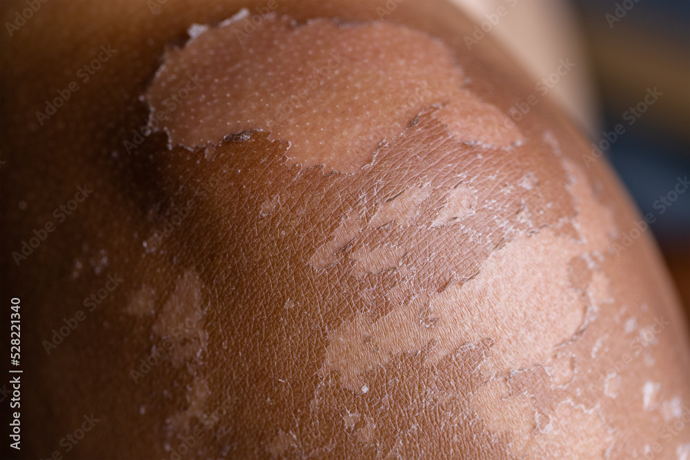 Fototapeta premium Male sunburned skin close up