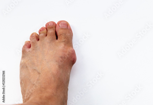 A deformed toe joint after successive gout attacks. Gout bunion. photo