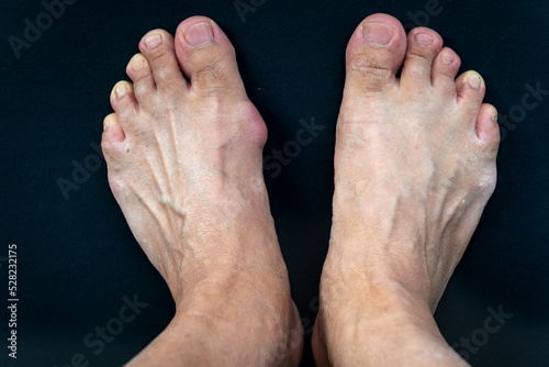 A foot with a gout bunion compared with a normal one isolated in black background. photo