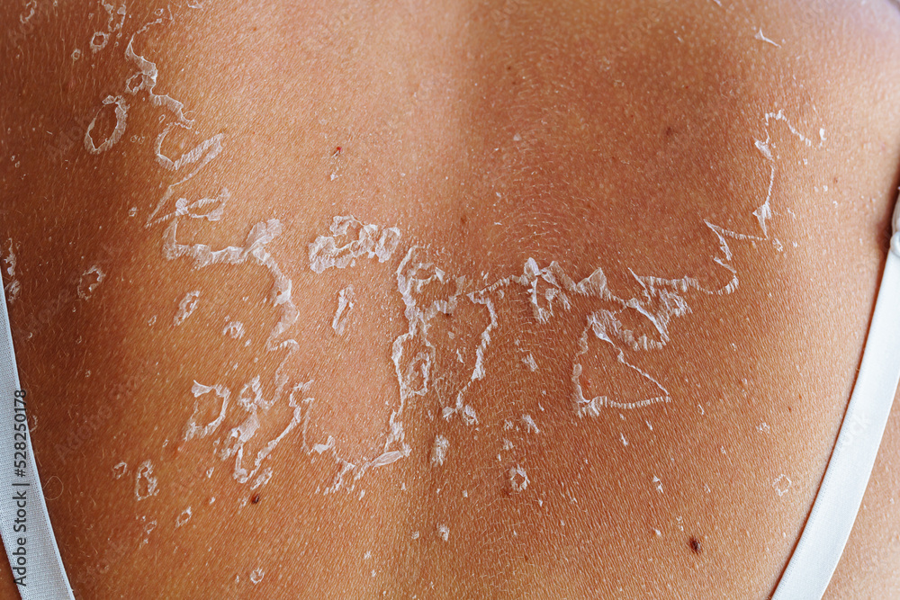 Fototapeta premium Back close-up with tank top straps, with sunburn, shabby flaky skin, reminiscent of outline of map of country Ukraine