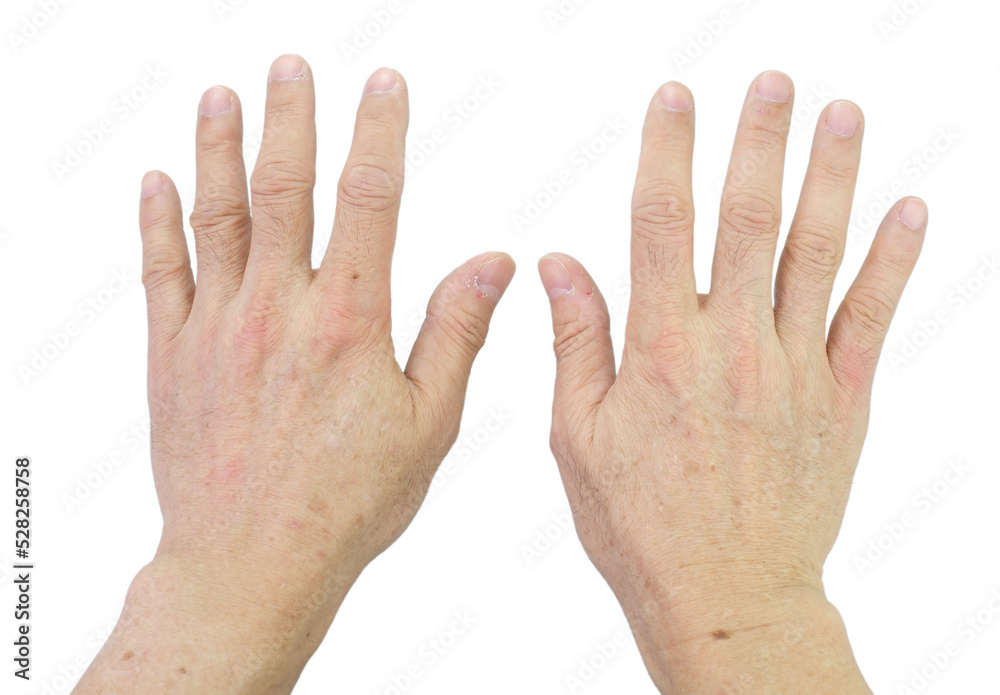 Small brown spots on the skin of the senior man's hands. Fingers and nails with dry skin, torn and flaking off, cracked skin on cuticles, Isolated on white background. Small brown spots on the skin of the senior man's hands. Fingers and nails with dry skin, torn and flaking off, cracked skin on cuticles, Isolated on white background.