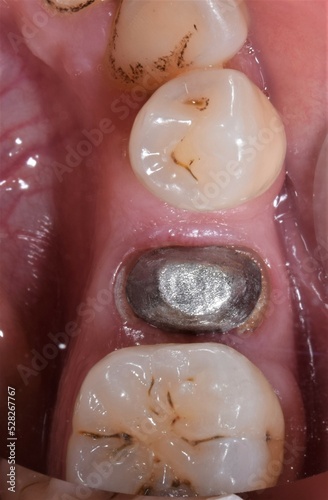 Inlaycore cemented and prepared in an inferior premolar root. Occlusal view of the tooth number 35 in the right hemiarch of the mandibule. Healthy gingival gum, black stain and decays in the teeth.