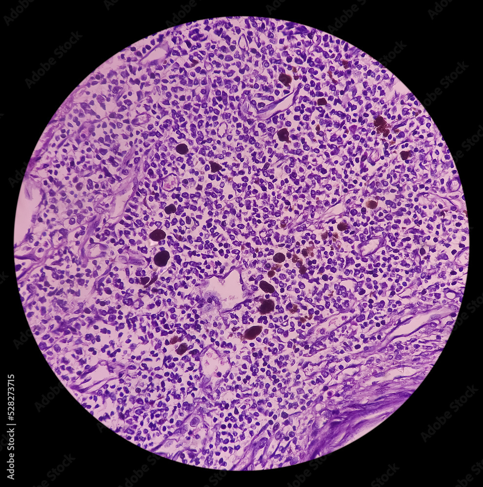 Skin biopsy, Scalp carcinoma, pigmented basal cell carcinoma, the most common type of sun