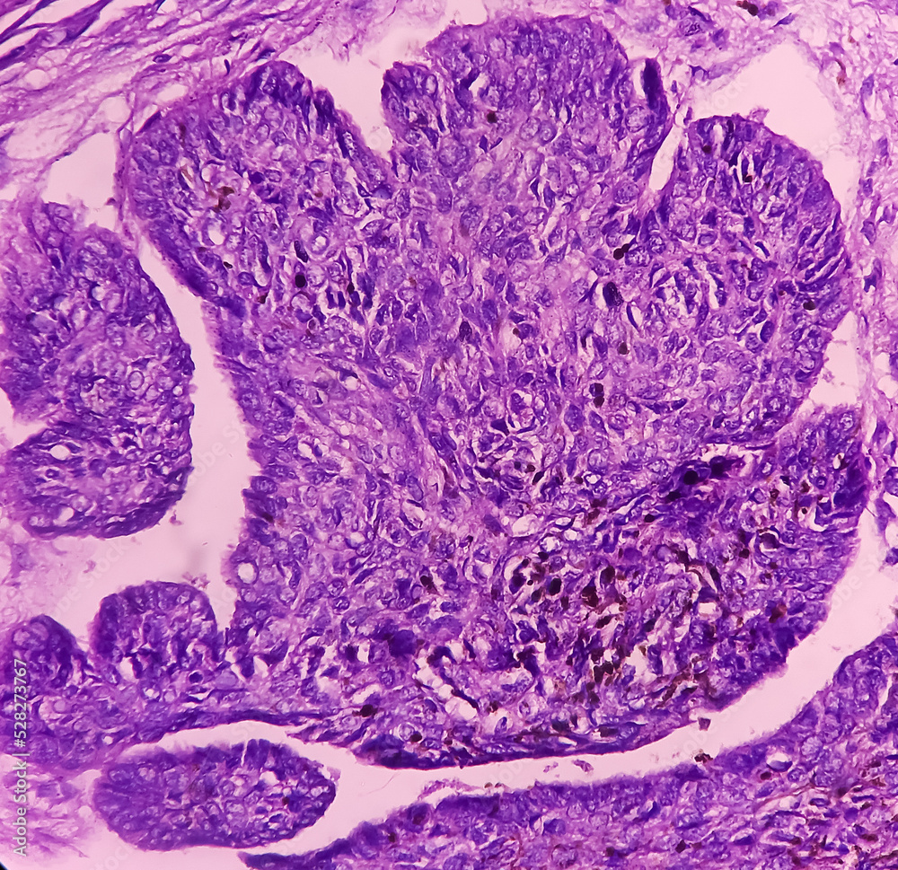 Skin biopsy, Scalp carcinoma, pigmented basal cell carcinoma, the most
