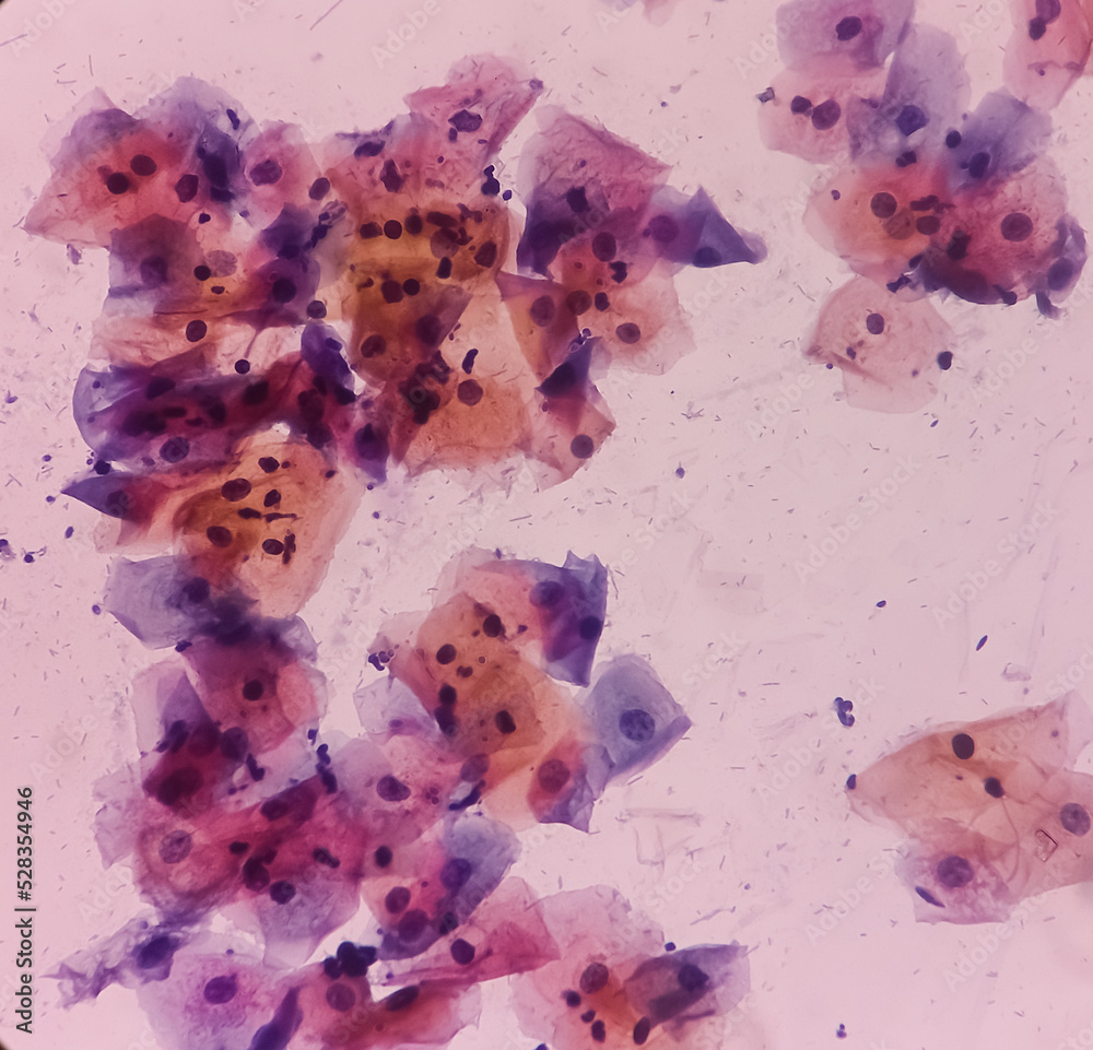 Abnormal squamous epithelial cells view in microscopy.HPV criteria for