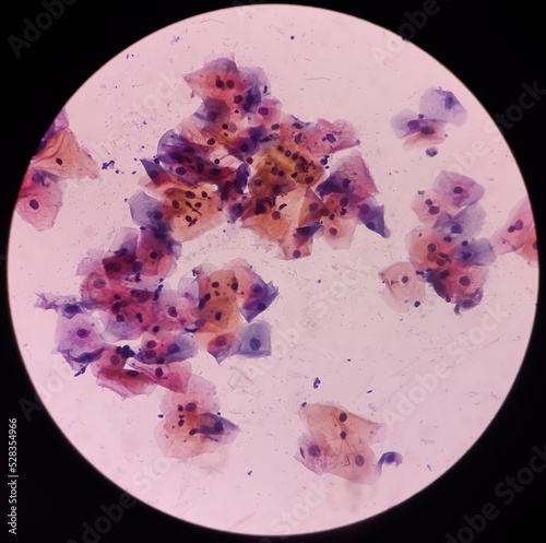 Abnormal squamous epithelial cells view in microscopy.HPV criteria for pap smear slide cytology. Medical concept. photo